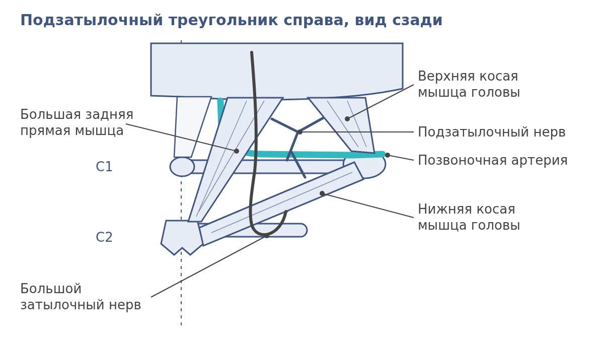 Схема подзатылочного треугольника справа: большая задняя прямая, верхняя и нижняя косые мышцы, позвоночная артерия, подзатылочный и большой затылочный нервы